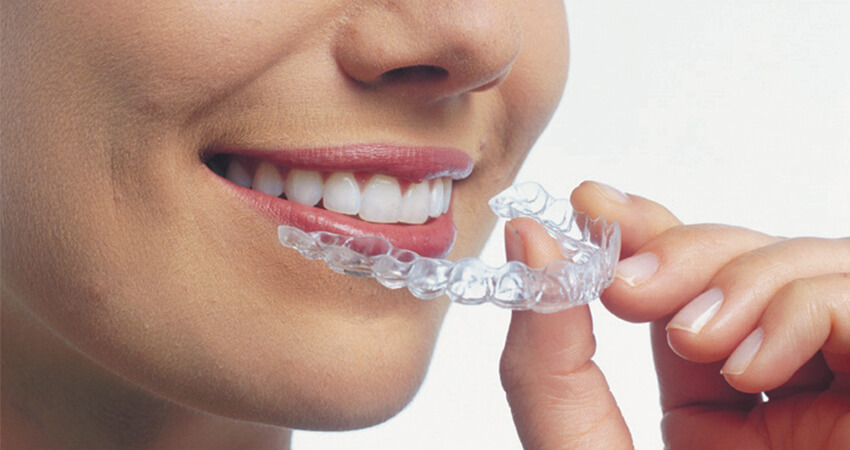 Clear-Aligners Clear-Aligners
